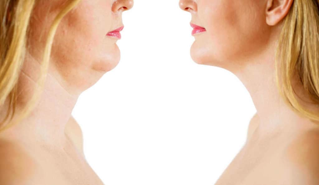 Double Chin treatment Lower Sydenham before and after results