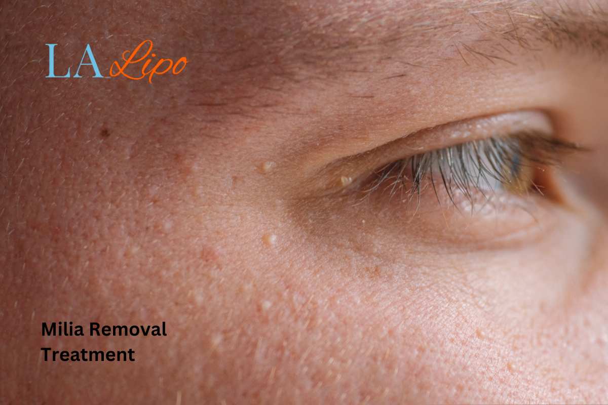 Cryopen Milia Removal: Is It the Easiest and Safest Option Lower Sydenham?