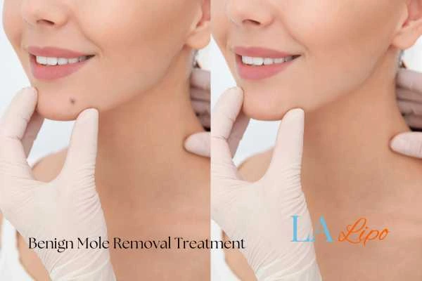 woman's before and after mole removal Lower Sydenham results