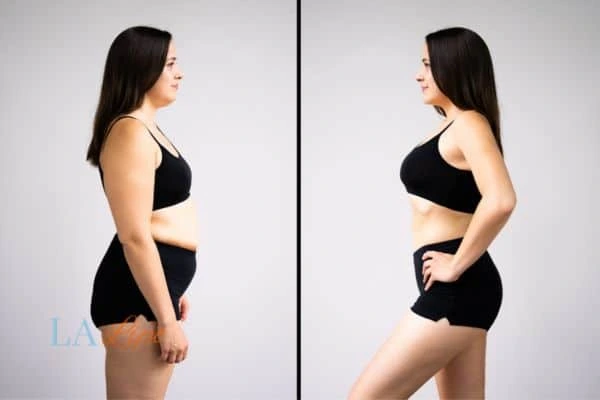 image of woman before and after results of LA-EMS Body Sculpting Lower Sydenham to help treat Diastasis recti