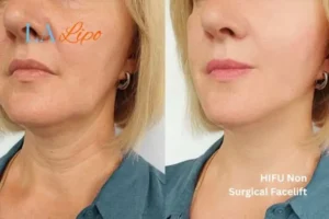 hi-fu for wrinkles Lower Sydenham before and after results