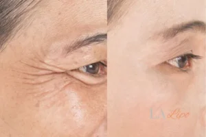 Before and after results of woman - HI-fu wrinkles reduction treatment Lower Sydenham
