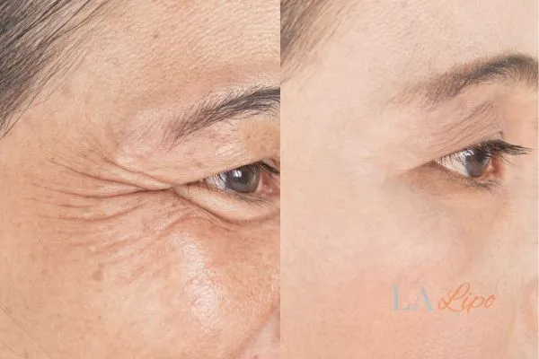 Before and after results of woman - HI-fu wrinkles reduction treatment Lower Sydenham