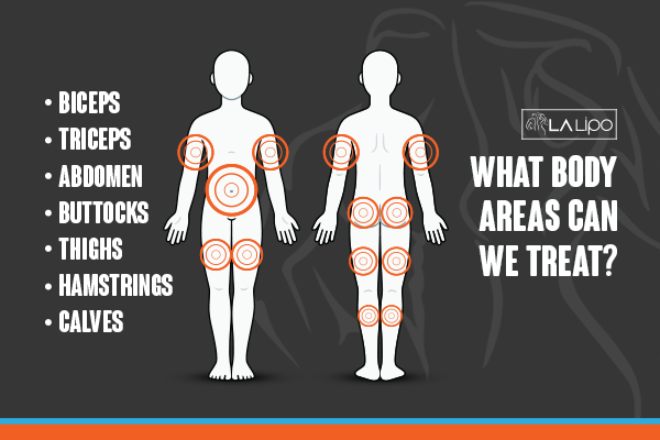 Graphic to show areas you can have LA-EMS Body Sculpting Lower Sydenham treatment.