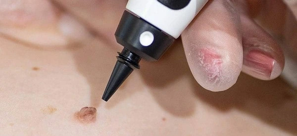 skin tag removal using cryopen Lower Sydenham