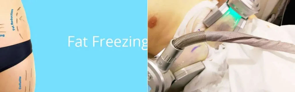 Fat freezing Lower Sydenham on multiple areas of the body