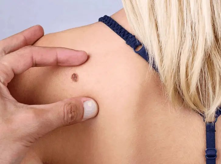 woman having mole removal Lower Sydenham consultation before treatment.