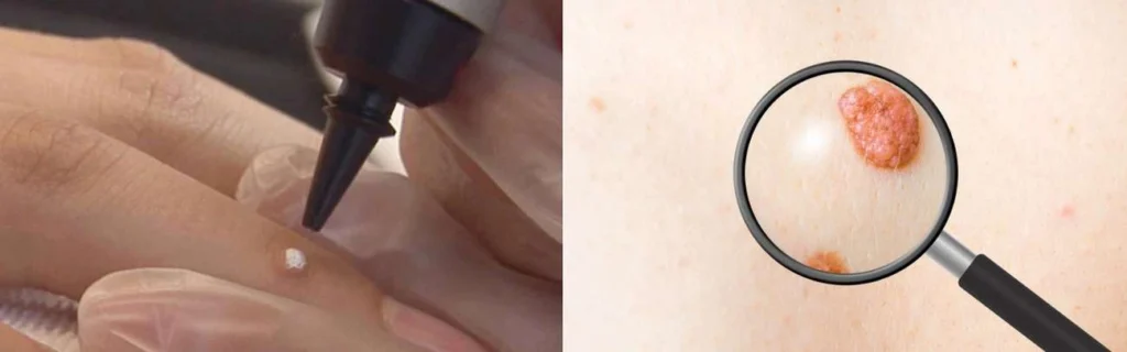 CryoPen practitioner Lower Sydenham assessing a benign mole before treatment