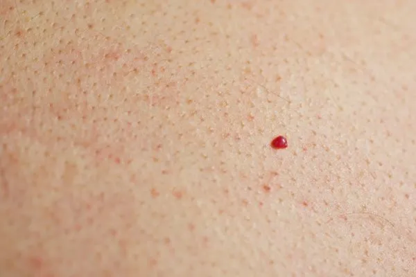 close up of a cherry angioma Lower Sydenham