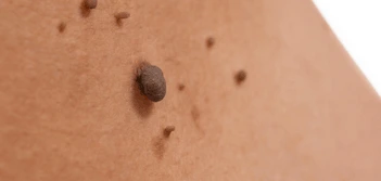 image of a skin tag Lower Sydenham