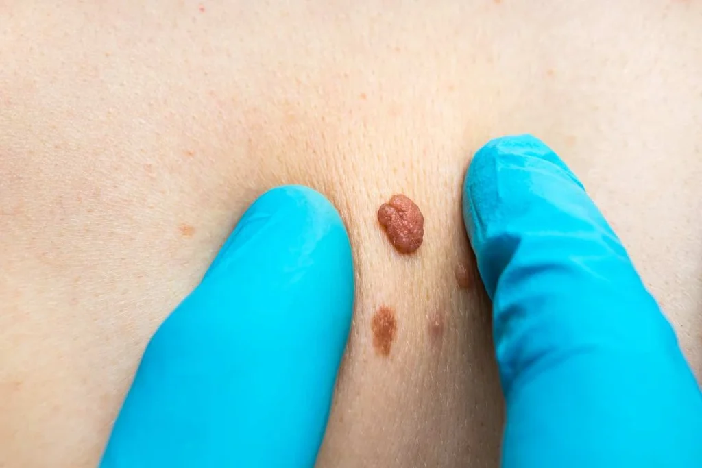 Consultant examining a skin tag Lower Sydenham