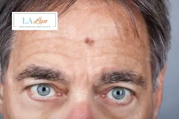 Solar Lentigo Removal Lower Sydenham image of man with mark on his forehead