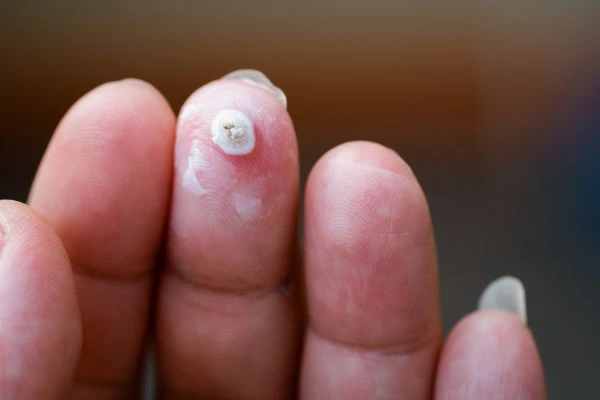 wart on person finger - cryotherapy to treat from LA LIPO Lower Sydenham