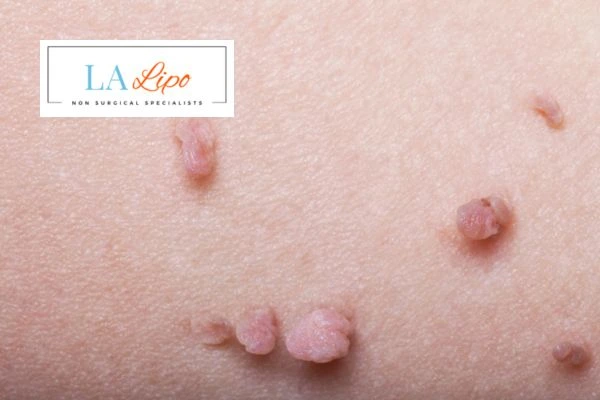 Does cryopen skin tag removal Lower Sydenham hurt? Find out now call our team today!