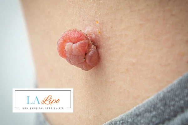 Interested in skin tag removal Lower Sydenham? Concerned about the pain? Find out more today!