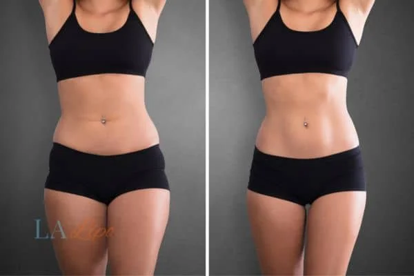 before and after results of non-surgical treatment to help a woman's body image and mental health Lower Sydenham