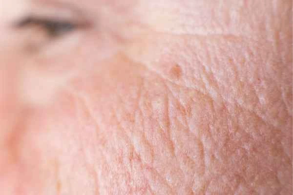 close up picture of a woman's face showing an age spot Lower Sydenham
