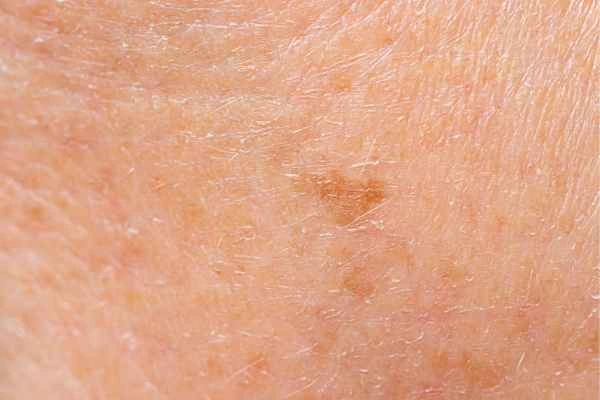 close up picture of age spots Lower Sydenham