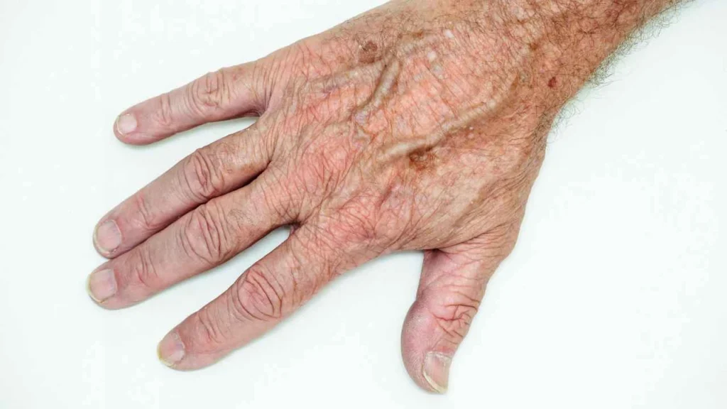 Male hand showing age spot Lower Sydenham