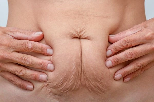 Image of a woman's stomach with loose skin - example of skin tightening Lower Sydenham options