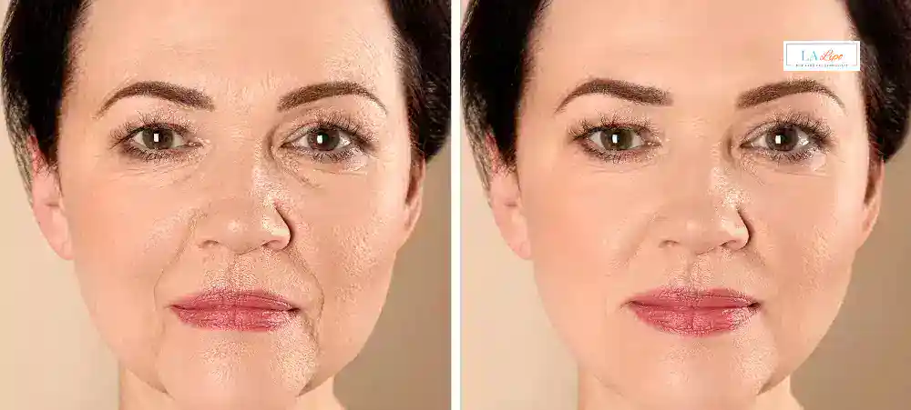How Long Does It Take to See Results and How Long Do They Last Lower Sydenham?