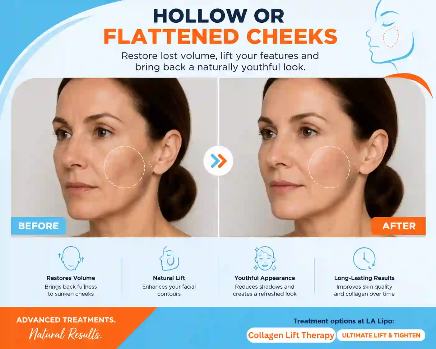 Sign #4: Hollow or Flattened Cheeks Lower Sydenham